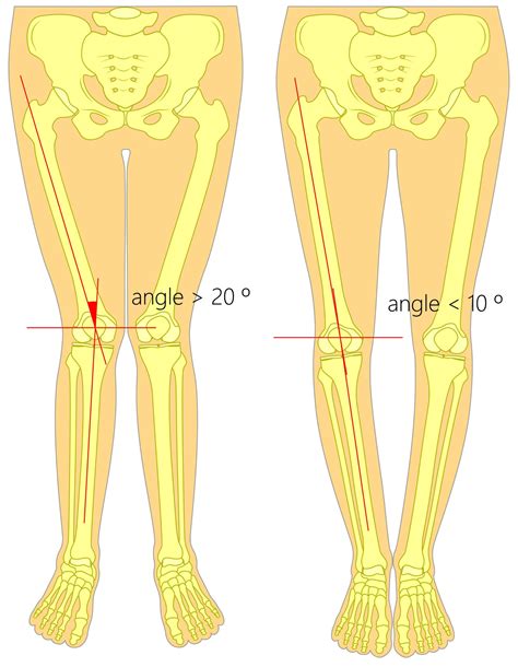 What Is Overpronation Overpronation Flat Feet Pain And How To Fix It