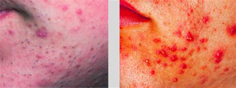 Acne Rosacea Follicular Sweat Glands Flashcards Quizlet