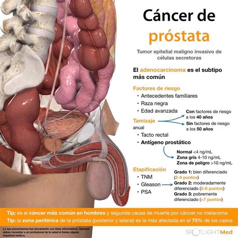 Cáncer de Próstata Fuente SpotlightMed Facebook Med School Anatomy