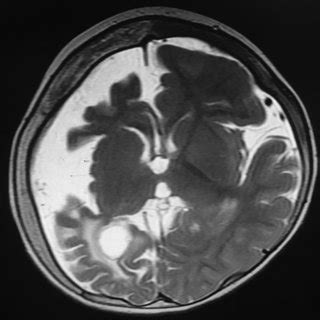 MRI brain (T2W image, axial cut) showing diffuse thinning and atrophy... | Download Scientific ...