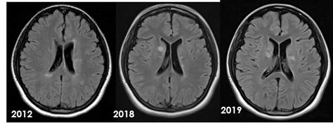 Multiple Sclerosis Radiology Cases