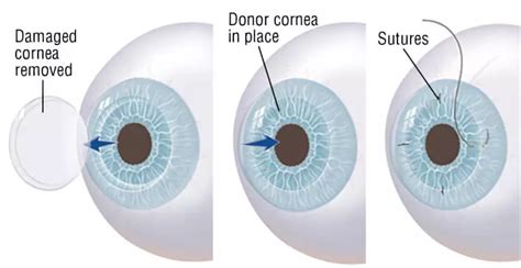 Cornea Transplantation Keratoplasty Surgery Booking Surgery