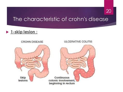 Pin On Crohns Fibromyalgia And My Health Issues