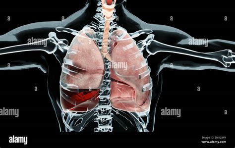 3d Illustration Of Hemopneumothorax Normal Lung Versus Collapsed