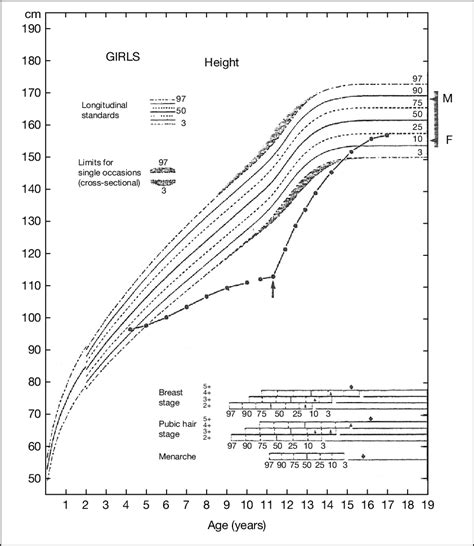 A child with growth hormone deficiency demonstrating catch-up growth ...