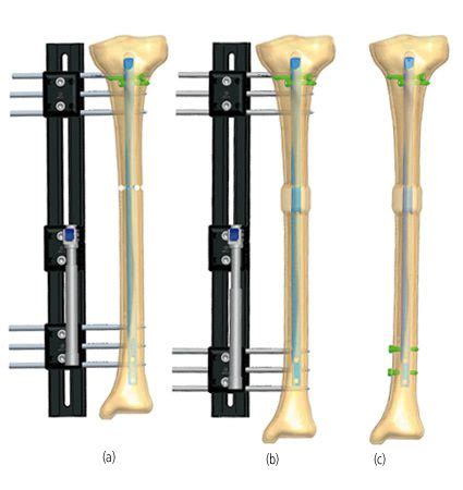 Tibia Lengthening Treatment Orthofix Abs