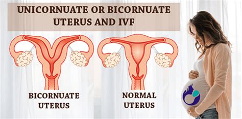 Unicornuate Or Bicornuate Uterus And Ivf Usha Ivf