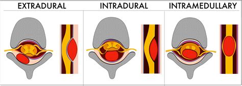 Whats Around The Spinal Cord Imaging Features Of Extramedullary