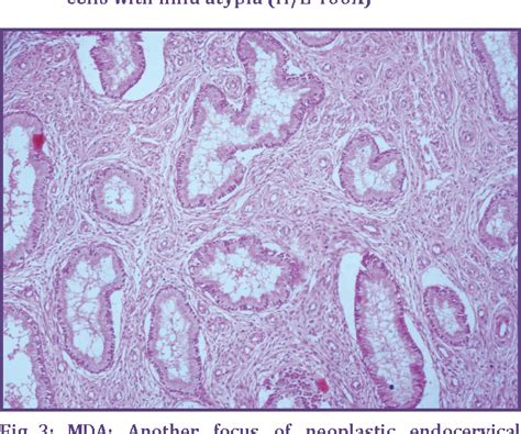 Figure 3 From Minimal Deviation Adenocarcinoma And Its Mimickers A