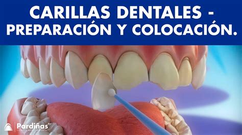 Carillas dentales Cómo se preparan y se colocan Porcelana y resina