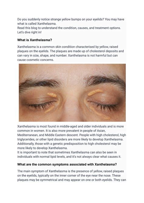 Understanding Xanthelasma The Weird Yellow Deposits On Your Eyelids