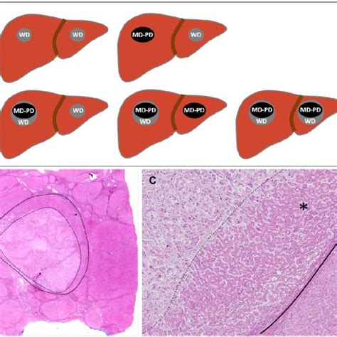 Multicentric Occurrence Of Hepatocellular Carcinoma Hcc And Nodule Download Scientific