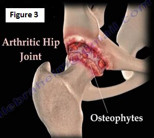 Common Causes Of Hip Pain | HuffPost Life