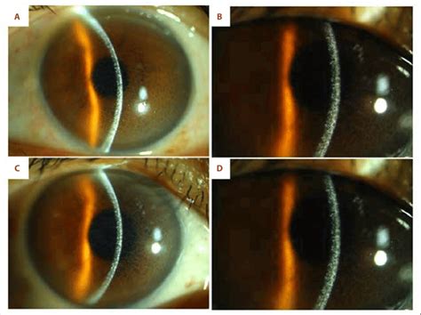 Slit Lamp Photograph Of The Right A B And Left C D Cornea