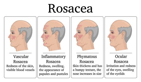 Can Tanning Help Rosacea Martlabpro