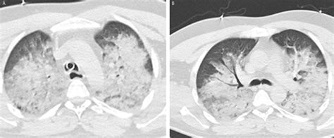 A case with neurogenic pulmonary edema