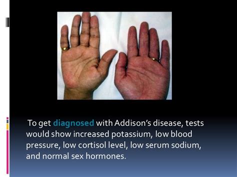 Addison’s Disease