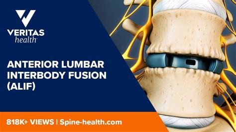 Anterior Lumbar Interbody Fusion Alif Youtube