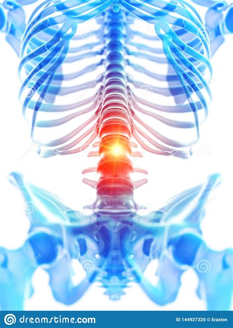 The Lumbar Spine Showing Pain Stock Illustration - Illustration of pain, inflammation: 144927320