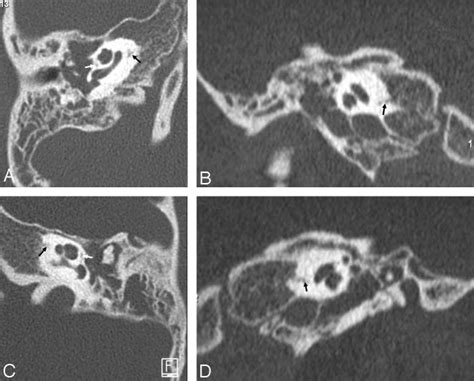 Six-year-old girl with complicated bilateral acute otitis media ...