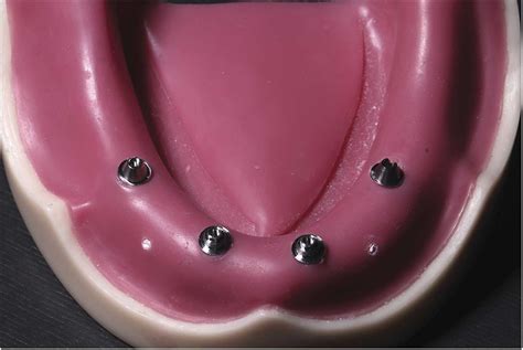 Evaluation Of Prosthetic Screw Loosening In All On Four Implant Supported Restorations With Two