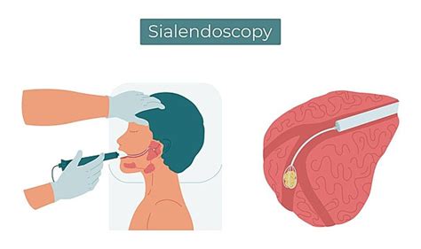 Sialendoscopy PNG Transparent Images Free Download | Vector Files | Pngtree