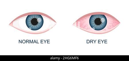 Irritación ocular Globo ocular inflamado con conjuntiva roja aislada