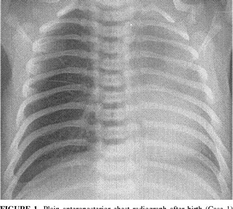 Perinatal Diagnosis And Management Of Congenital Bronchial Stenosis Or