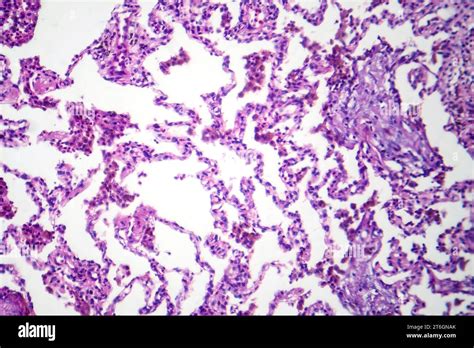 Photomicrograph Of Lobar Pneumonia In Dissolved Dissipate Period