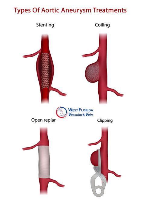 Tampa Aortic Aneurysm Surgery Treatment Center | Safety Harbor