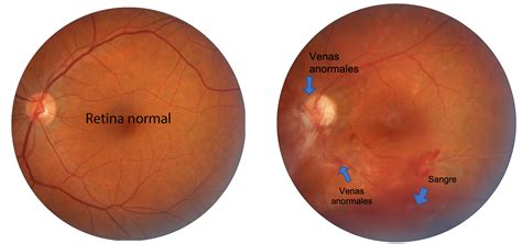 Fotocoagulación con láser Retina Center Tijuana