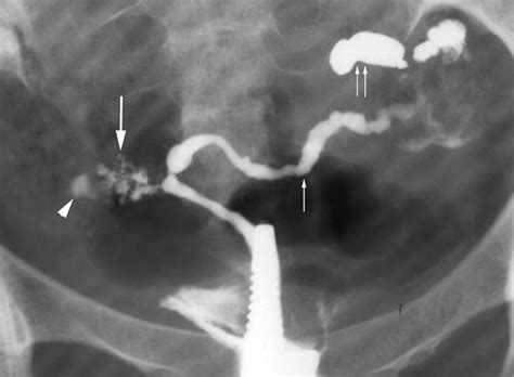 Hysterosalpingography And Ultrasonography Findings Of Female Genital