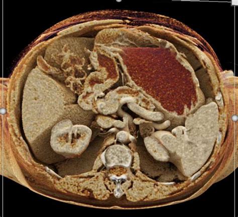 Pancreatic Cancer With Dilated Pancreatic Duct And Incidental Gist