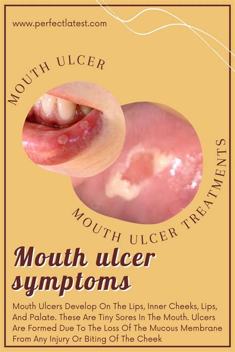 What Is A Mouth Ulcer Top Mouth Ulcer Treatments Mouth Ulcer Symptoms