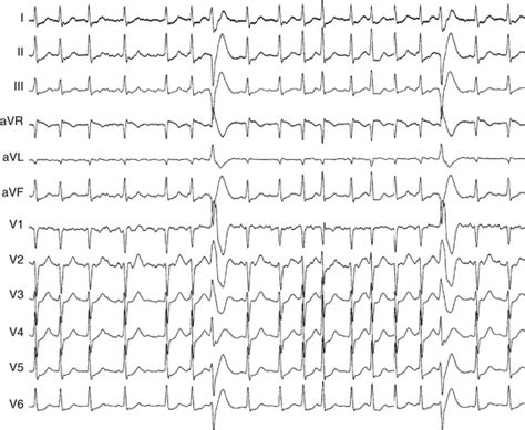 Intraventricular Conduction Abnormalities Clinical Gate