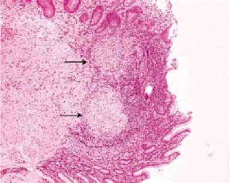 Case 1 Photomicrograph Of Gastric Biopsy Specimen Shows Non Caseating Download Scientific