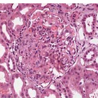 Kidney Biopsy Showing Cellular Crescents With Glomerular Vascular