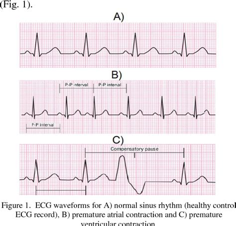 Premature Atrial Contraction Vs Premature Ventricular Contraction