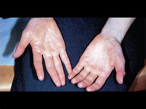 Acrocyanosis Symptoms and Causes - Diagnosis - Treatment - Prevention ...