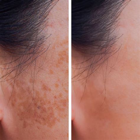 Laser Pigmentation Removal In Santa Rosa And Healdsburg