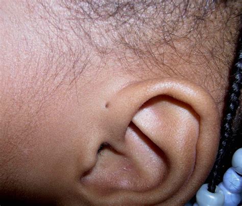 Hole In Ear What To Know