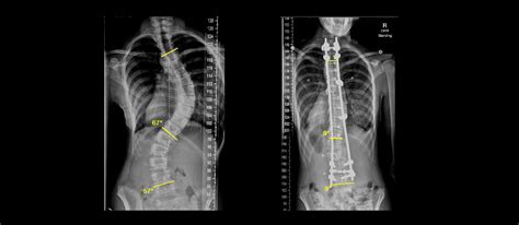 My Journey with an "S" Curve and Adolescent Idiopathic Scoliosis