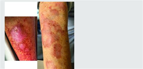 Erythematous Rash With Annular Discoloured Plaques In Both Forearms Download Scientific