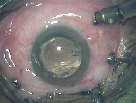 Clearer Vision Ahead Vitrectomy For Floater Relief Eye Surgery Guide