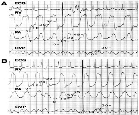 Constrictive Pericarditis Intraoperative Hemodynamic And Ec