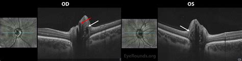 Optic Disc Drusen. EyeRounds.org: Online Ophthalmic Atlas