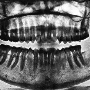 Orthopantomograph Showing A Unilocular Radiolucent Lesion In The Ramus