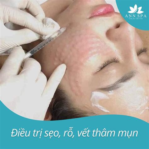 Tiêm Mesotherapy Là Gì Tiêm Mesotherapy Có Tốt Không Ann Spa