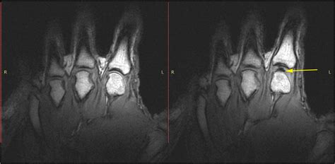 Knuckle Cracking Rmedicine