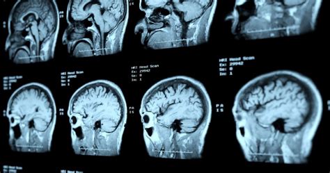 Tumor Cerebral Sintomas Causas Tipos E Tratamento Minha Vida